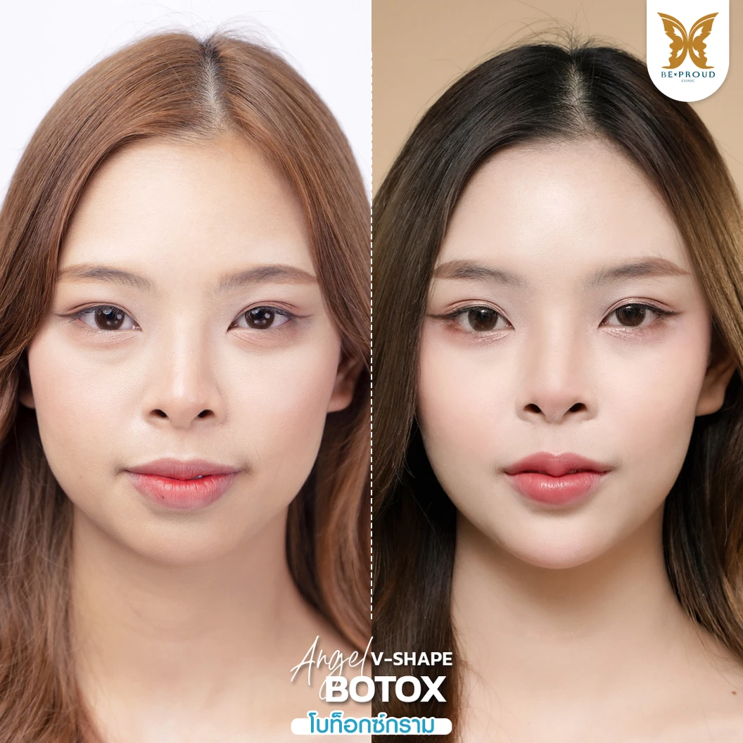 โปรแกรมโบท็อกซ์ 100 ยูนิต (บริเวณที่มีปัญหา)