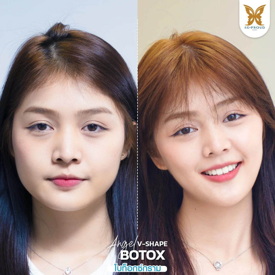 โปรแกรมโบท็อกซ์ 100 ยูนิต (บริเวณที่มีปัญหา)