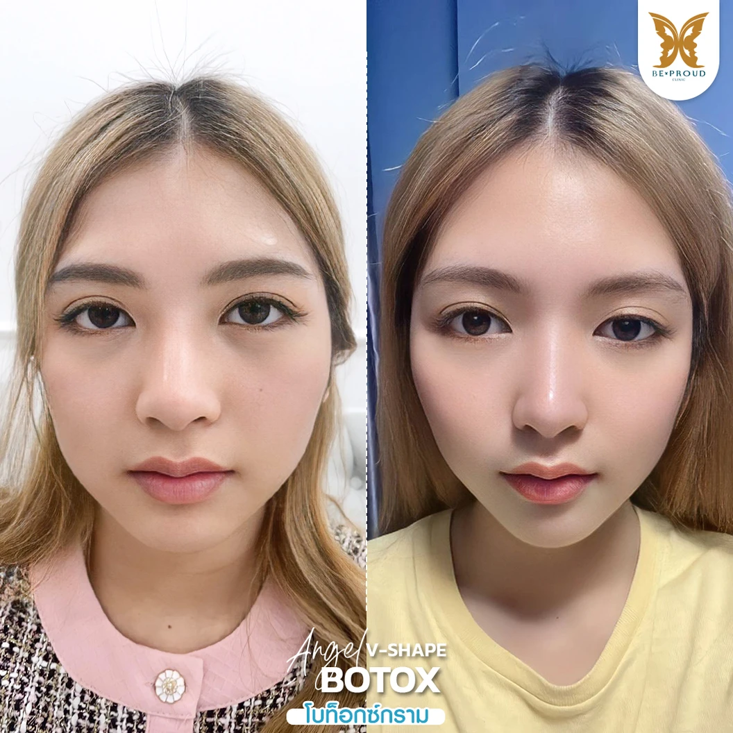 โปรแกรมโบท็อกซ์ 100 ยูนิต (บริเวณที่มีปัญหา)