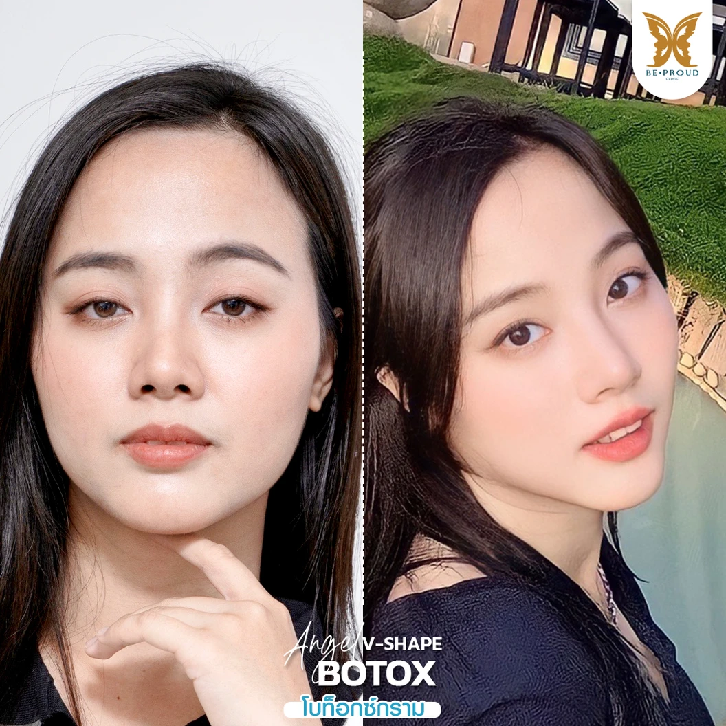 โปรแกรมโบท็อกซ์ 100 ยูนิต (บริเวณที่มีปัญหา)