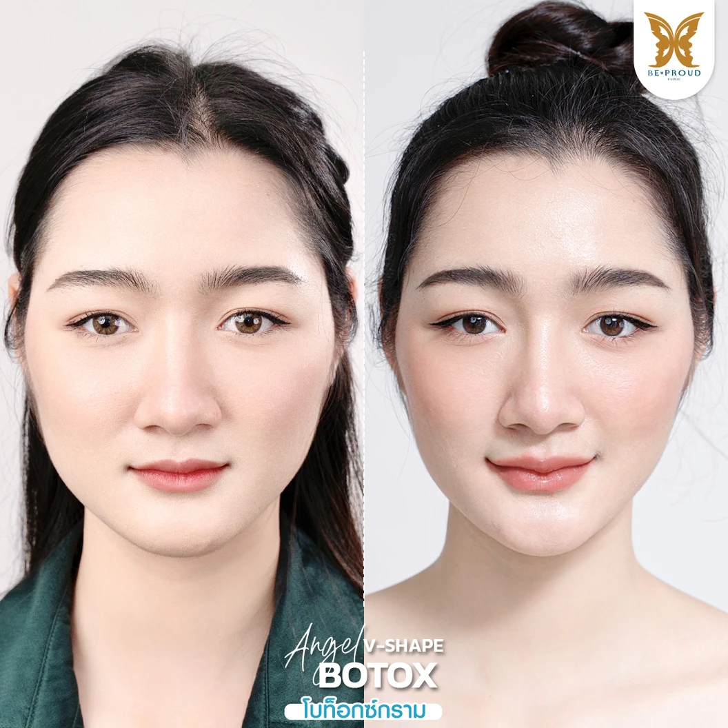 โปรแกรมโบท็อกซ์ 100 ยูนิต (บริเวณที่มีปัญหา)