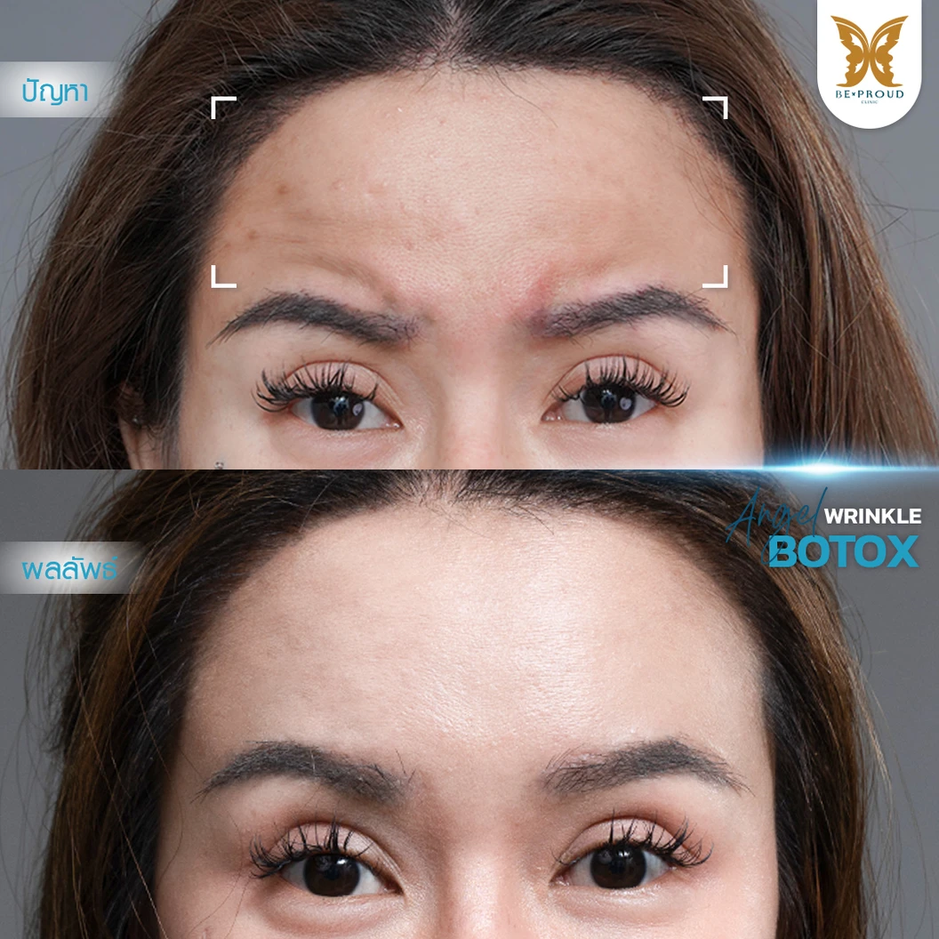 โปรแกรมโบท็อกซ์ 100 ยูนิต (บริเวณที่มีปัญหา)