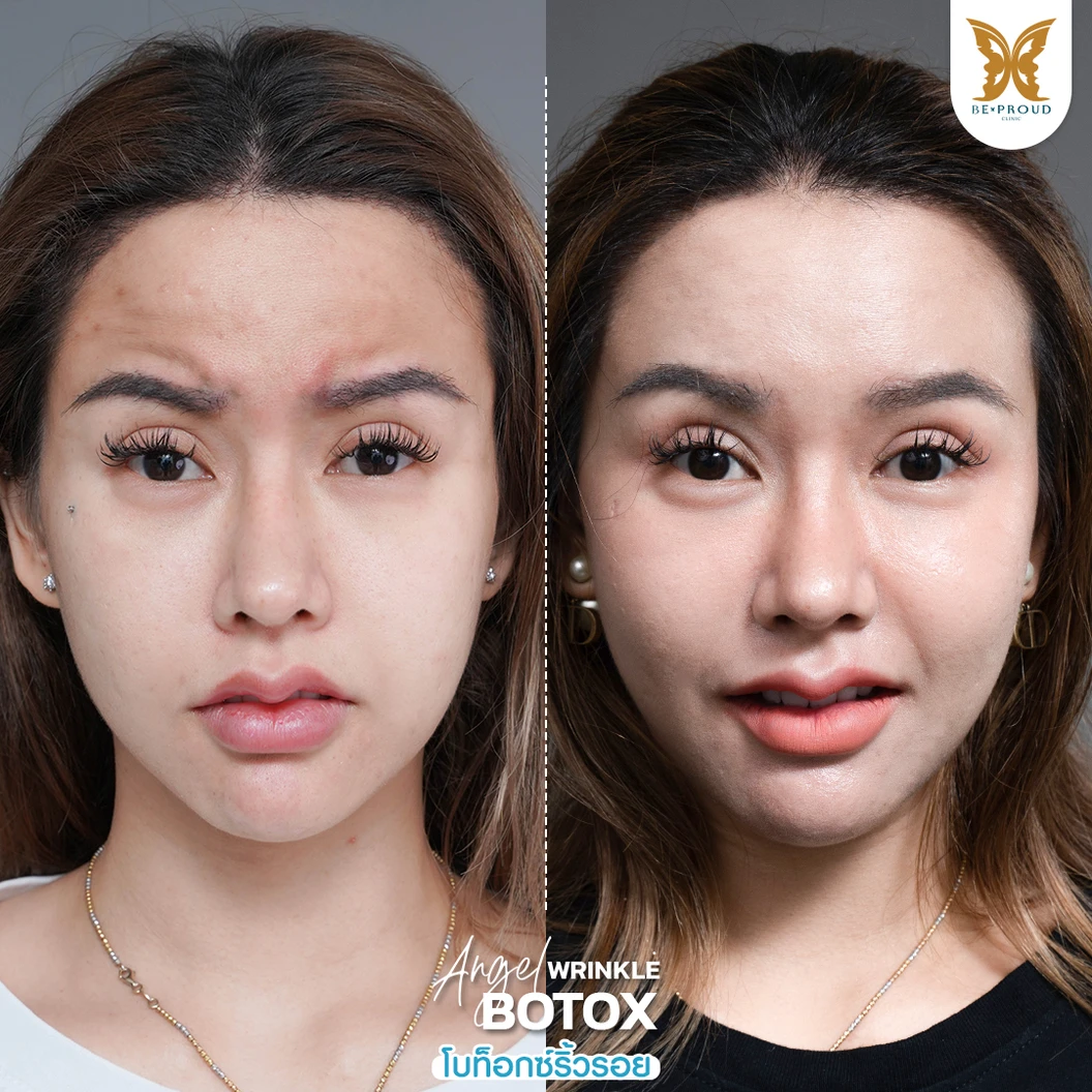 โปรแกรมโบท็อกซ์ 100 ยูนิต (บริเวณที่มีปัญหา)