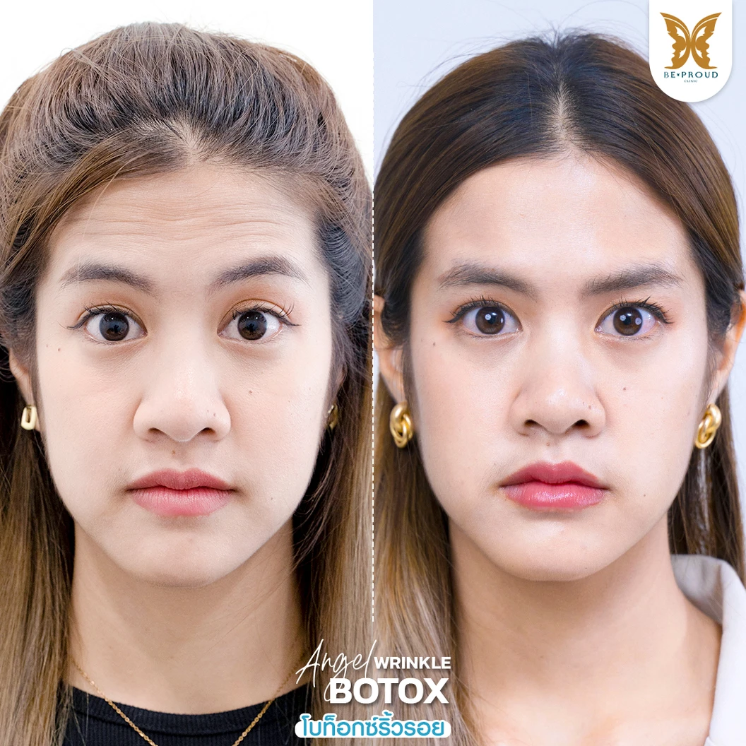 โปรแกรมโบท็อกซ์ 100 ยูนิต (บริเวณที่มีปัญหา)