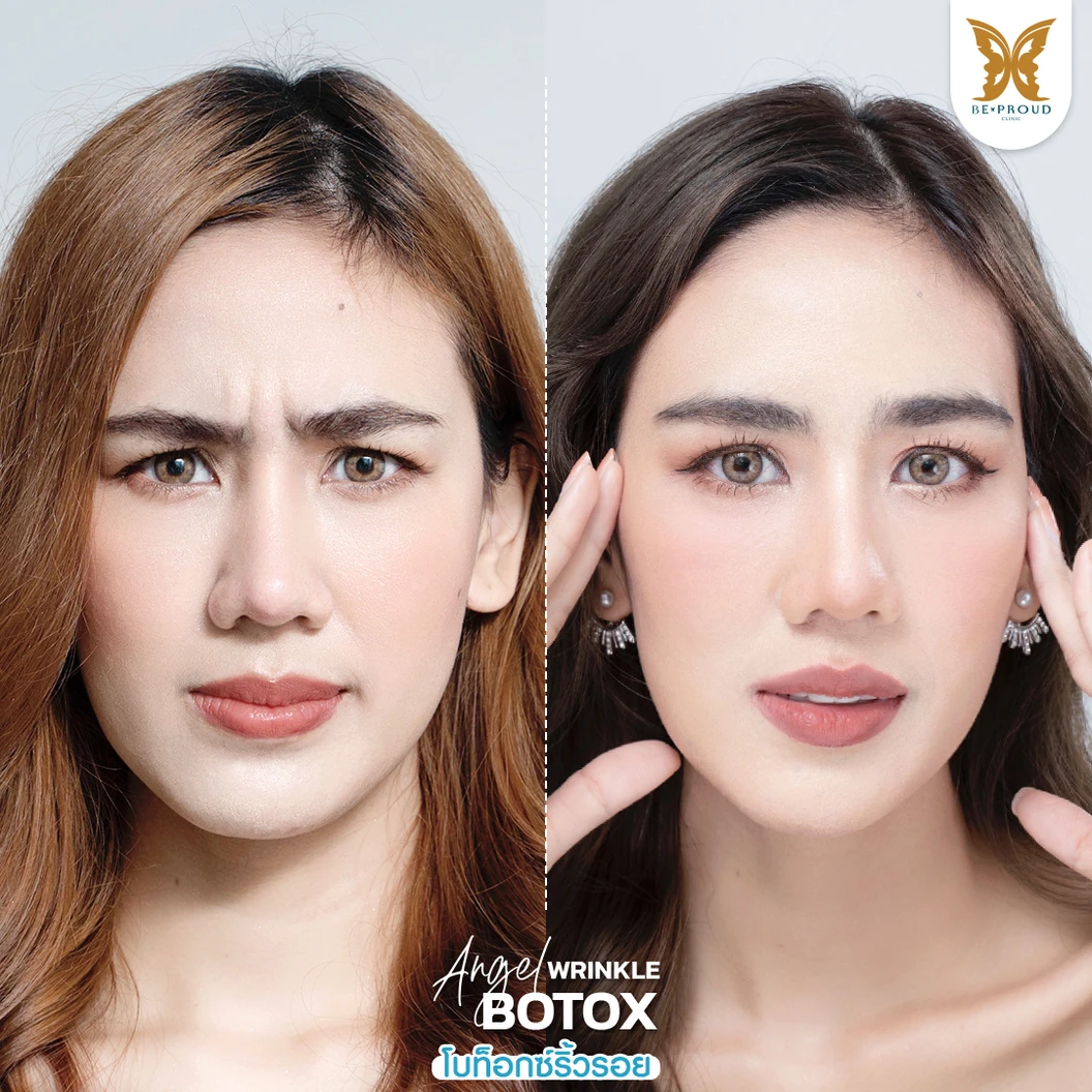 โปรแกรมโบท็อกซ์ 100 ยูนิต (บริเวณที่มีปัญหา)