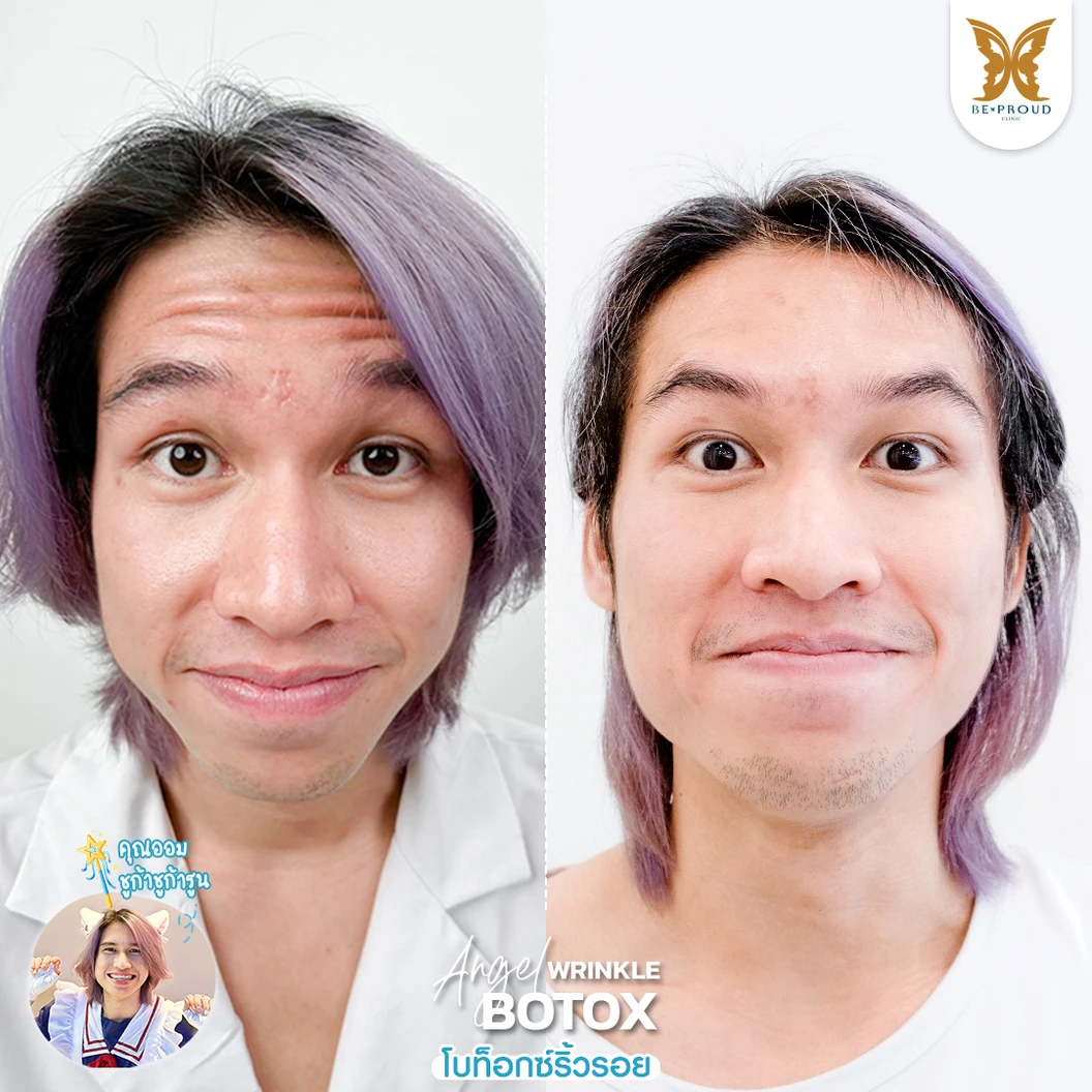 โปรแกรมโบท็อกซ์ 100 ยูนิต (บริเวณที่มีปัญหา)