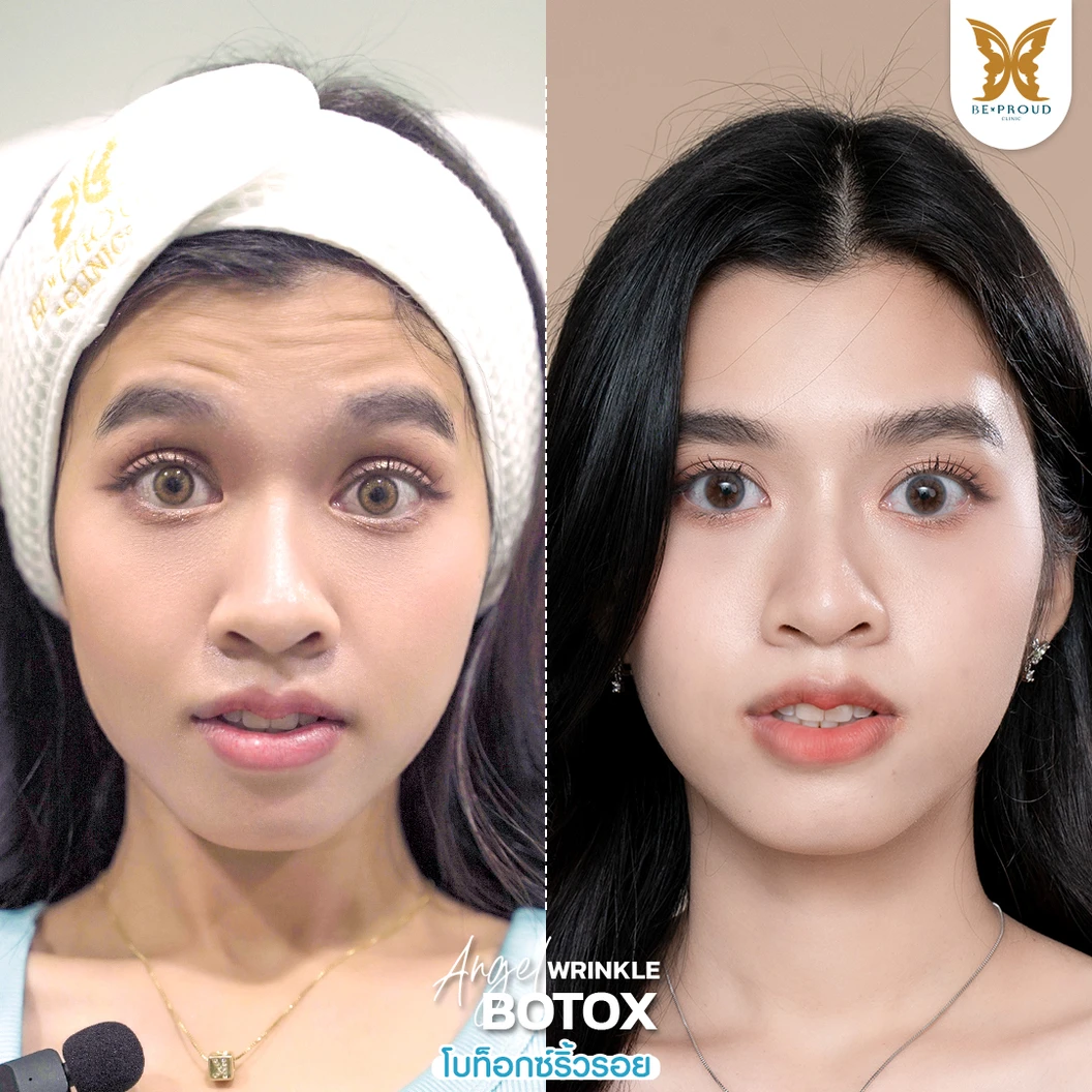 โปรแกรมโบท็อกซ์ 100 ยูนิต (บริเวณที่มีปัญหา)