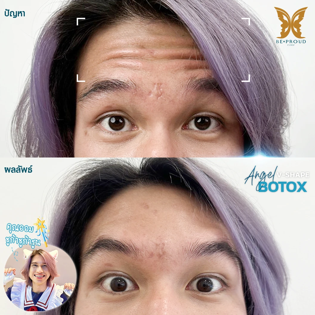 โปรแกรมโบท็อกซ์ 100 ยูนิต (บริเวณที่มีปัญหา)