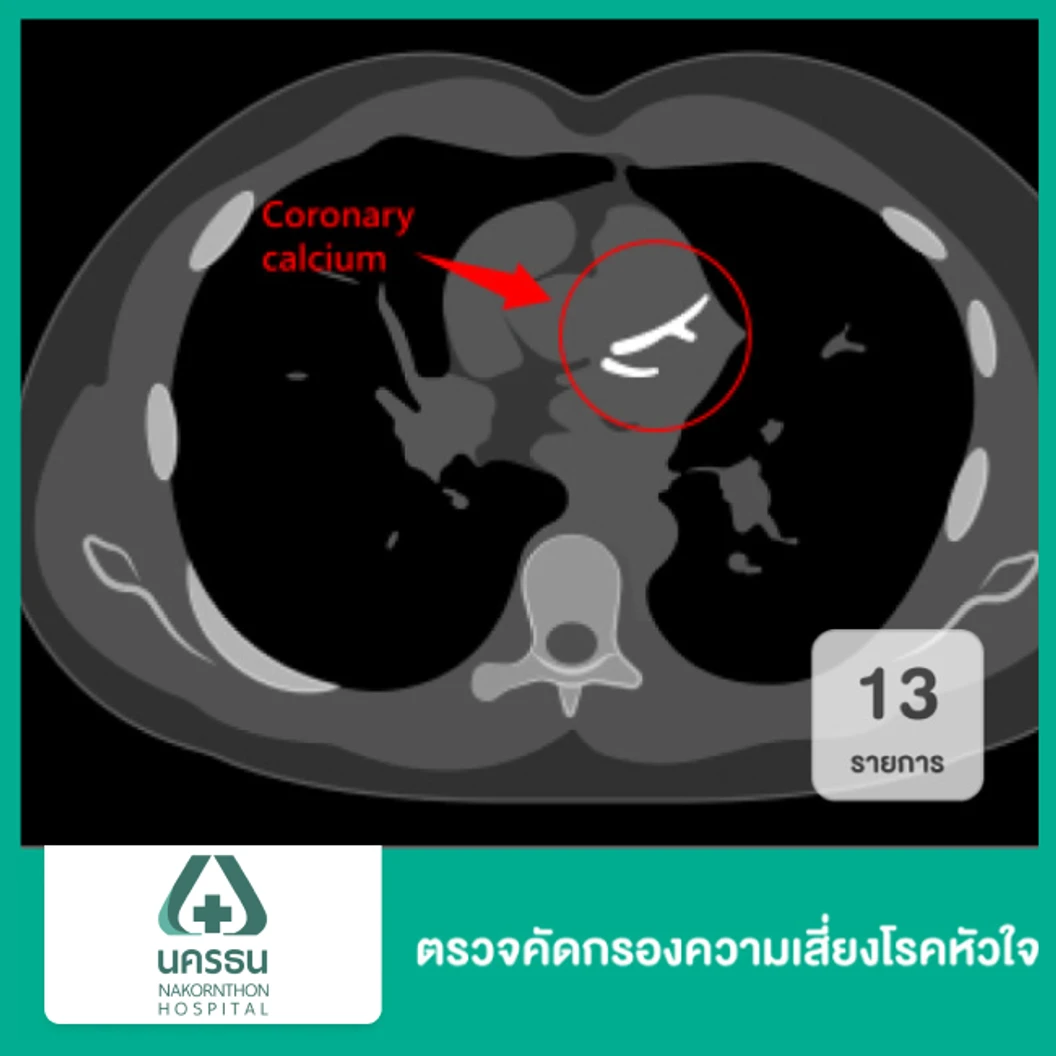 ตรวจคัดกรองความเสี่ยงโรคหัวใจ 13 รายการ Strong Heart CT Calcium Score