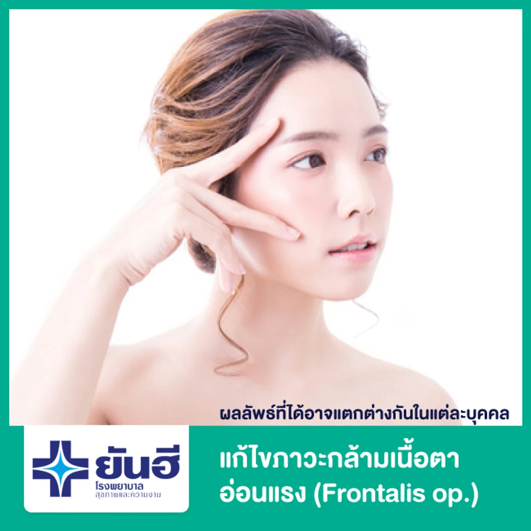 แก้ไขภาวะกล้ามเนื้อตาอ่อนแรง (Frontalis op.) 2 ข้าง สำหรับผู้ที่มีอาการมาก