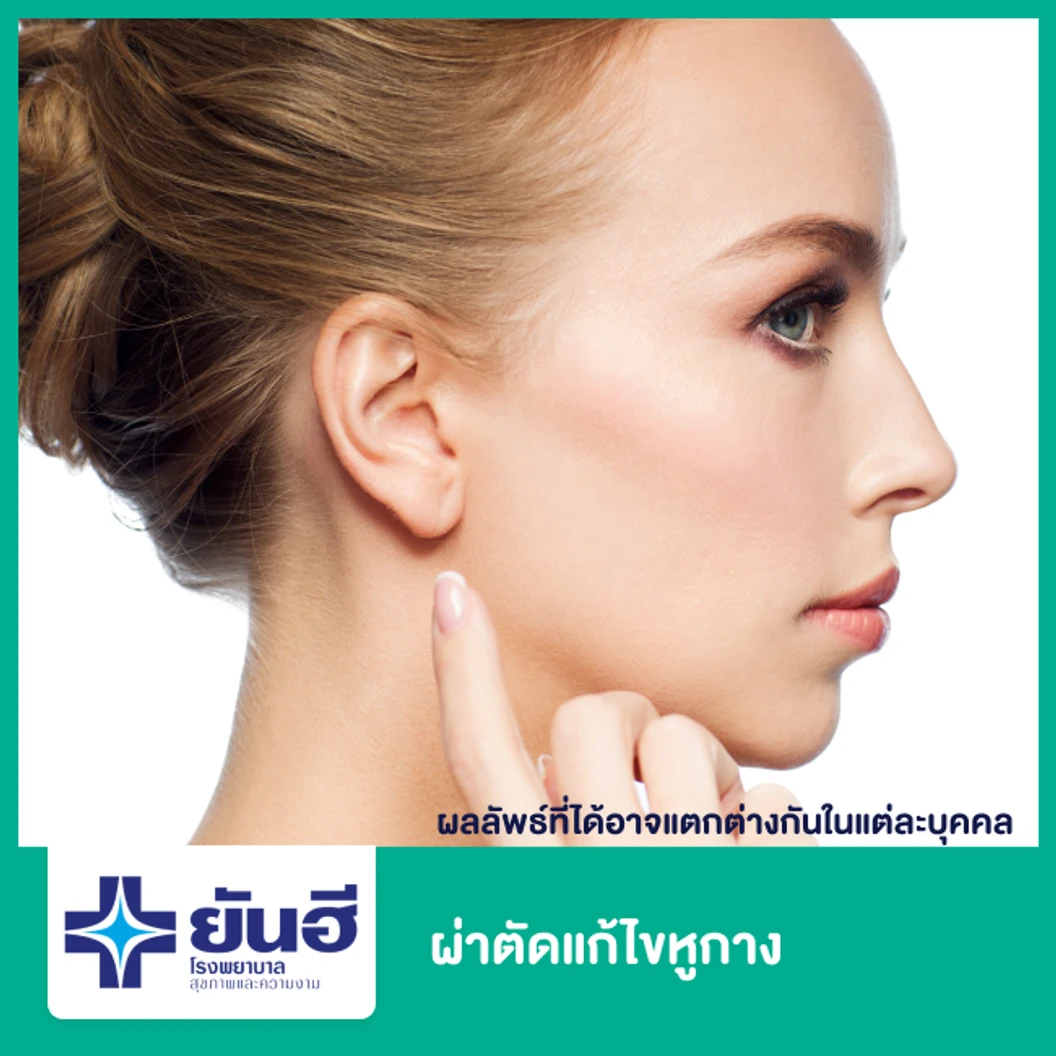 ผ่าตัดแก้ไขหูกาง 1 ข้าง