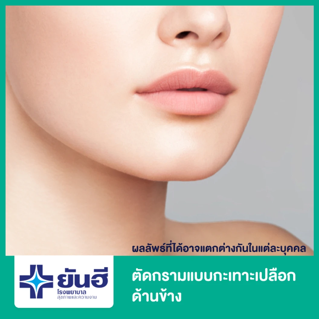 ตัดกรามแบบกะเทาะเปลือกด้านข้าง (Lateral Cortex Removal) พักฟื้นที่รพ. 2 คืน
