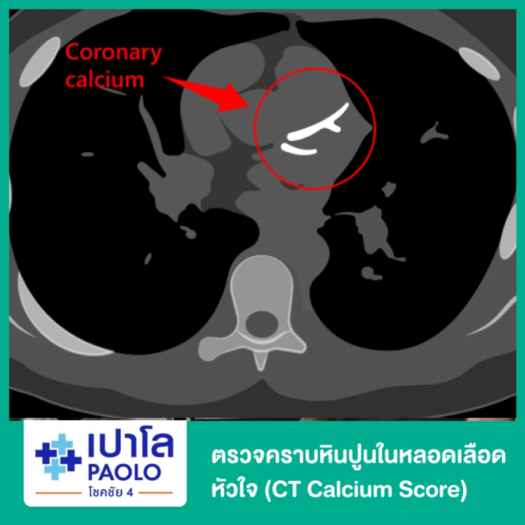 ตรวจคราบหินปูนในหลอดเลือดหัวใจ (CT Calcium Score)