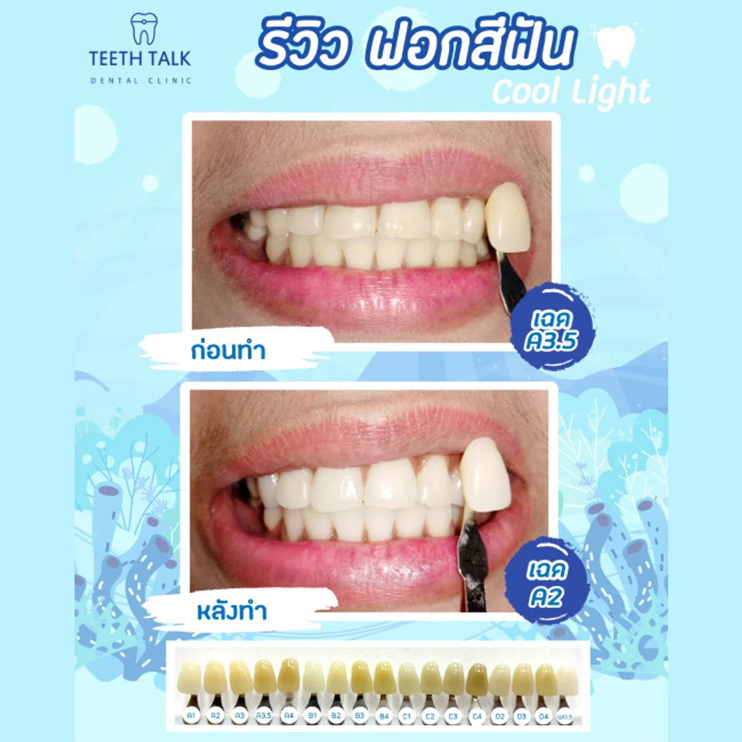 ฟอกสีฟันที่คลินิก ด้วยระบบ Cool Light