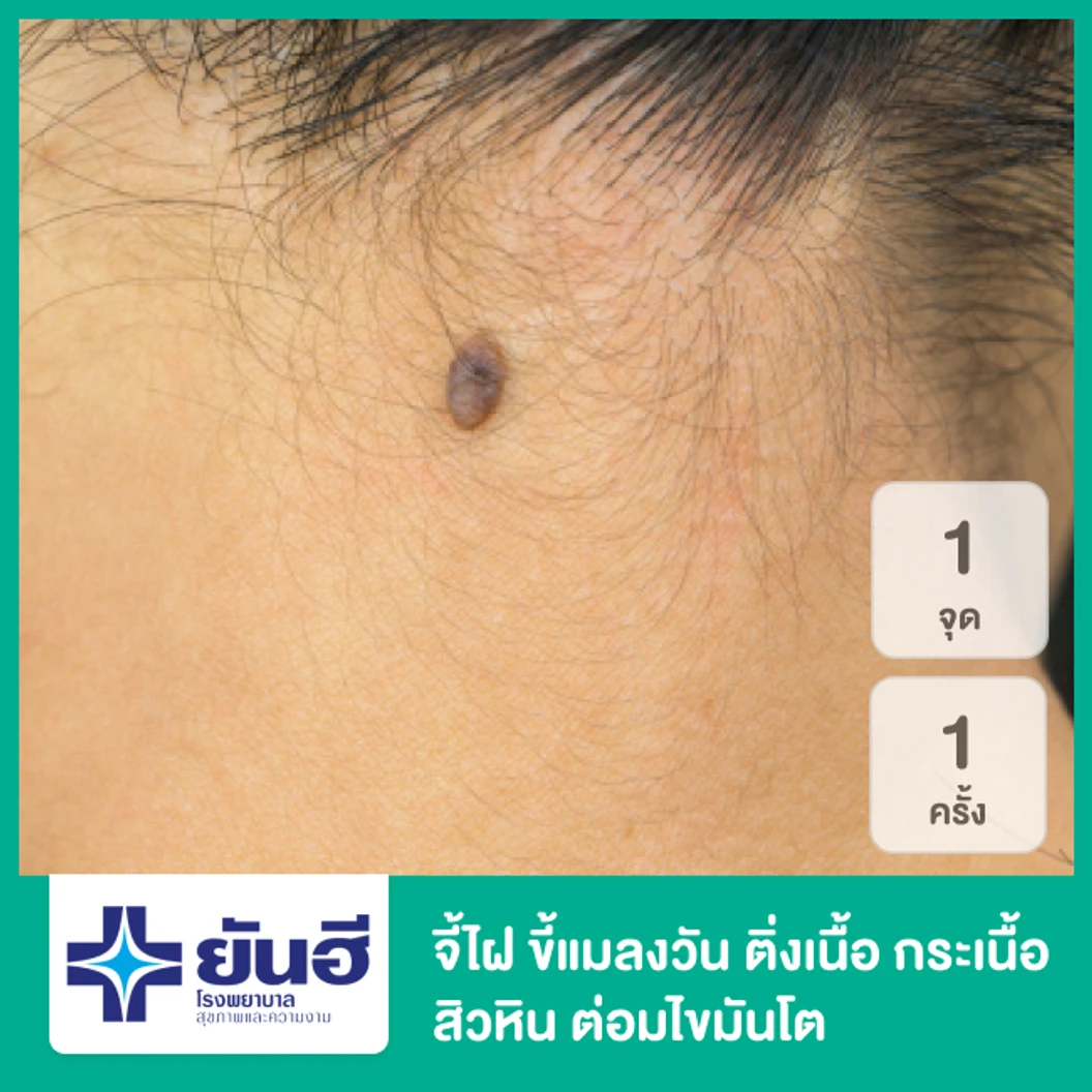 จี้ไฝ ขี้แมลงวัน ติ่งเนื้อ กระเนื้อ สิวหิน ต่อมไขมันโต ด้วยเลเซอร์ CO2 1 จุด 1 ครั้ง