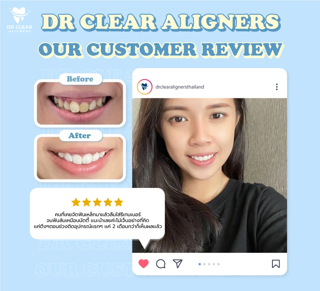 จัดฟันแบบใส Dr. Clear Aligners ฟันบนและล่าง