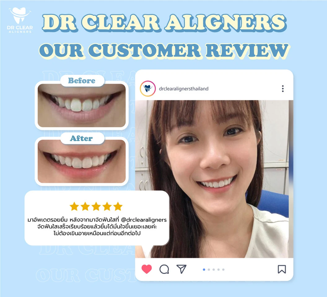 จัดฟันแบบใส Dr. Clear Aligners ฟันบนและล่าง