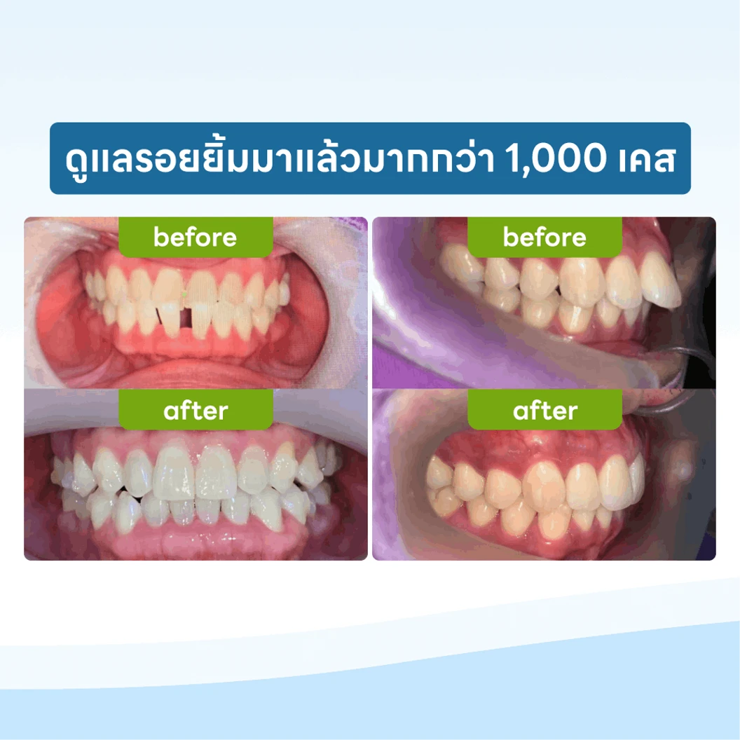 จัดฟันใส Invisalign Full Comprehensive ฟันบนและล่าง