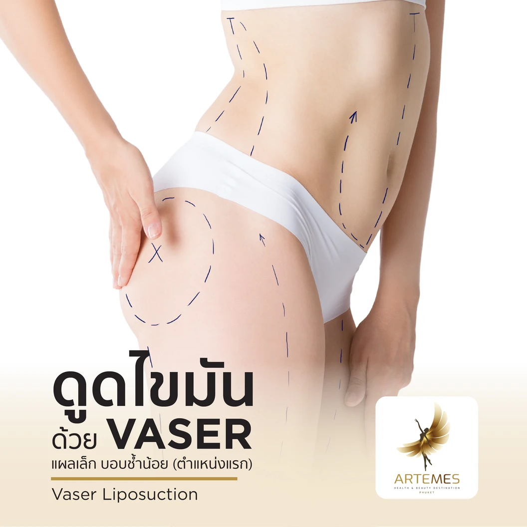 ดูดไขมันด้วยเครื่อง VASER เลือก 1 บริเวณ หน้าท้องบน หน้าท้องล่าง แขน ขา หรือสะโพก สำหรับผู้ที่มีค่า BMI ไม่เกิน 30 นอนพักที่ รพ. 1 คืน