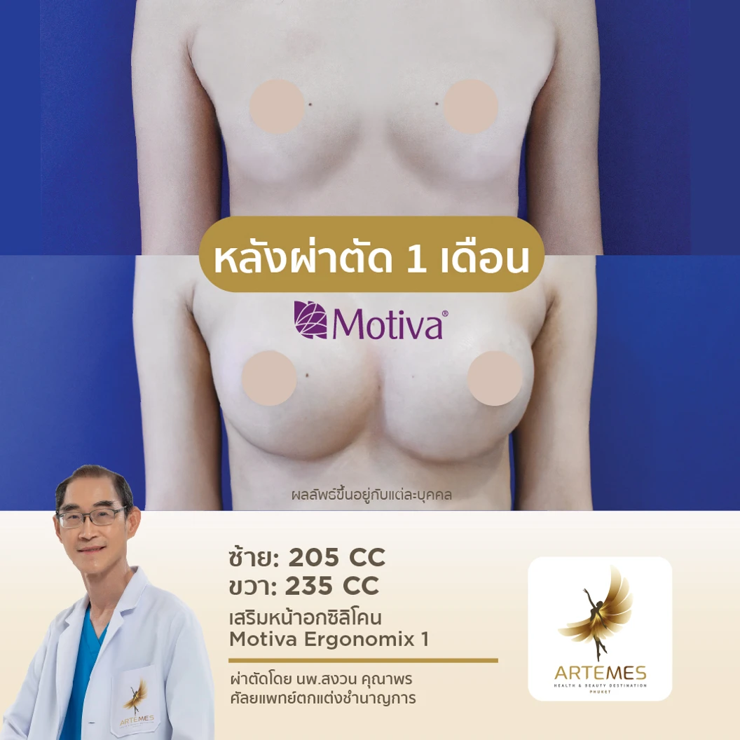 เสริมหน้าอกด้วยซิลิโคน Motiva รุ่น Ergonomix 1 จำนวนซีซีขึ้นอยู่กับแพทย์ประเมิน สำหรับเคสทำครั้งแรก นอนพักที่ รพ. 1 คืน