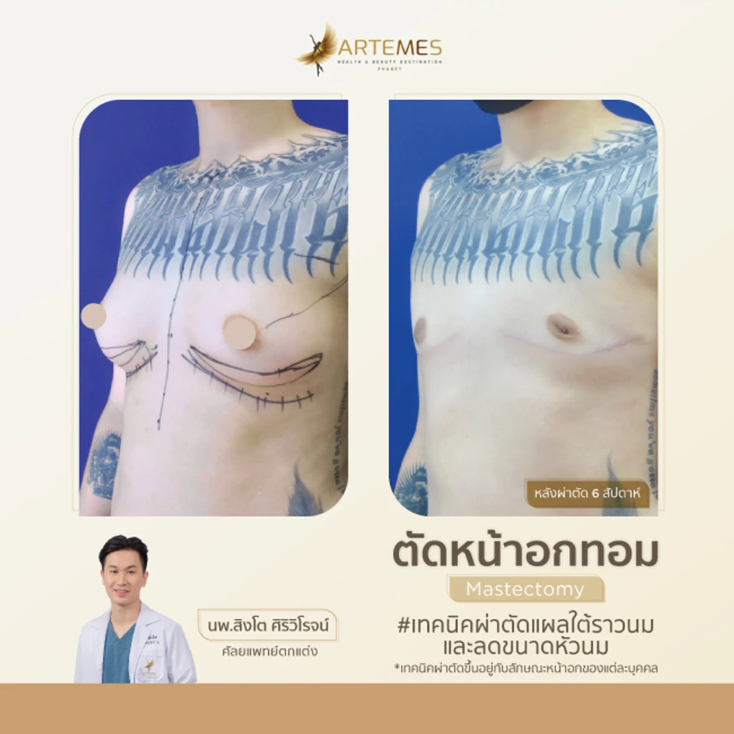 ตัดหน้าอก สำหรับผู้ที่มีขนาดหน้าอกคัพ B หรือ C เทคนิคขึ้นอยู่กับแพทย์ประเมิน สำหรับเคสทำครั้งแรก นอนพักที่ รพ. 2 คืน