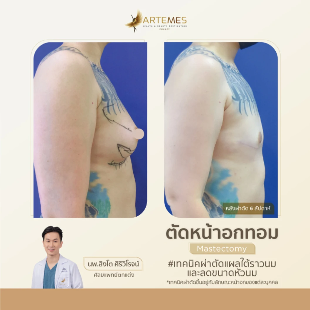 ตัดหน้าอก สำหรับผู้ที่มีขนาดหน้าอกคัพ B หรือ C เทคนิคขึ้นอยู่กับแพทย์ประเมิน สำหรับเคสทำครั้งแรก นอนพักที่ รพ. 2 คืน