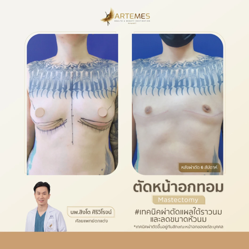 ตัดหน้าอก สำหรับผู้ที่มีขนาดหน้าอกคัพ B หรือ C เทคนิคขึ้นอยู่กับแพทย์ประเมิน สำหรับเคสทำครั้งแรก นอนพักที่ รพ. 2 คืน