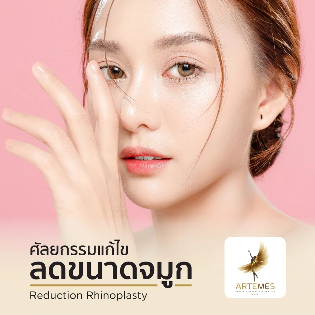 ศัลยกรรมลดขนาดจมูกให้เล็กลง Reduction Rhinoplasty สำหรับเคสทำครั้งแรก นอนพักที่ รพ. 2 คืน