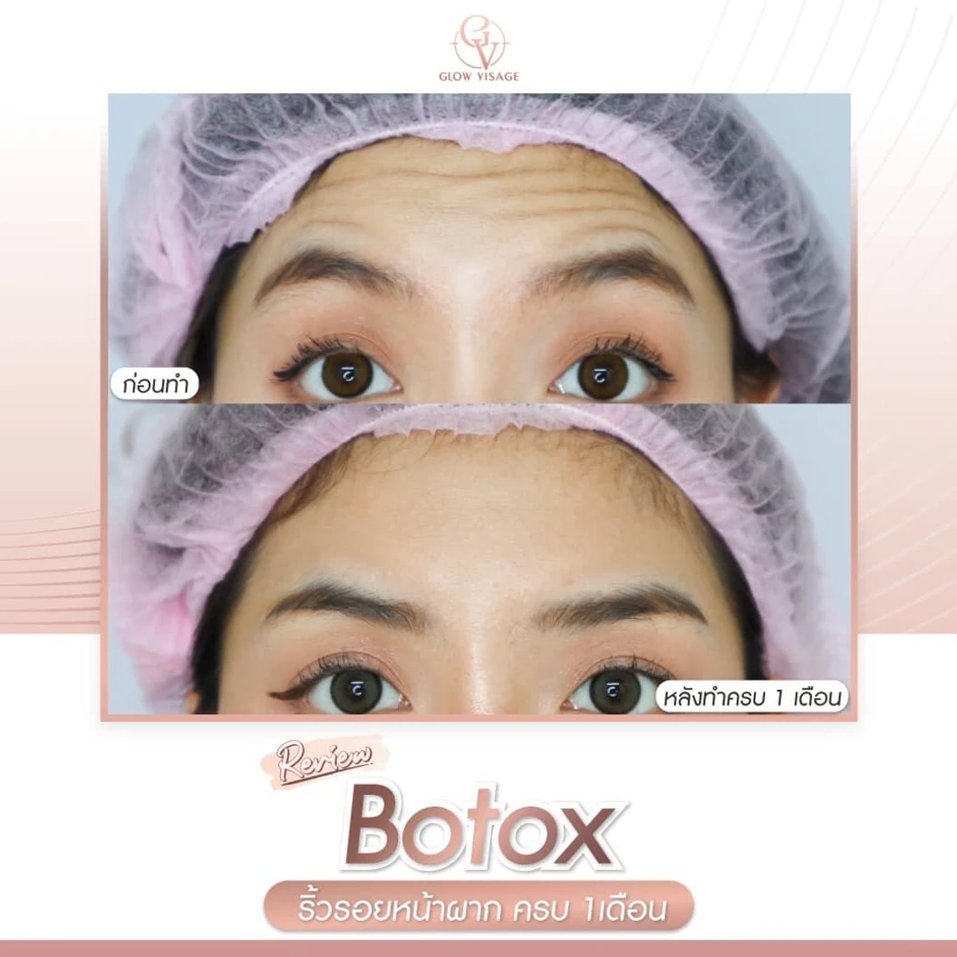 โปรแกรมโบท็อกซ์ จำนวนยูนิตขึ้นอยู่กับแพทย์ประเมิน (ลดริ้วรอย)