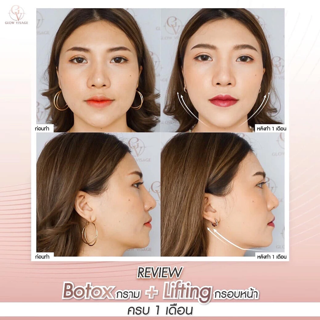 โปรแกรมโบท็อกซ์ จำนวนยูนิตขึ้นอยู่กับแพทย์ประเมิน (ลิฟกรอบหน้า)