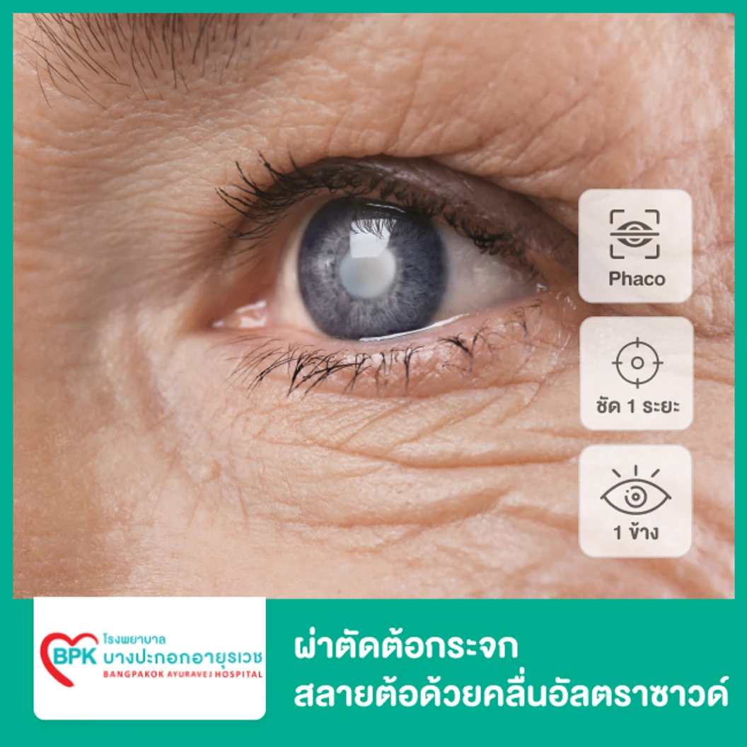 ผ่าตัดต้อกระจก สลายต้อด้วยคลื่นอัลตราซาวด์ เลนส์พับได้ ชัด 1 ระยะ สำหรับตา 1 ข้าง นอนพักที่ รพ. 1 คืน