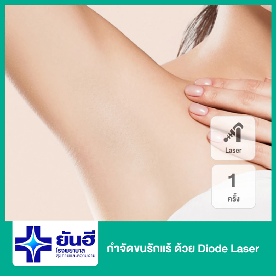 เลเซอร์ Diode Soprano ICE Platinum กำจัดขนรักแร้ 1 ครั้ง