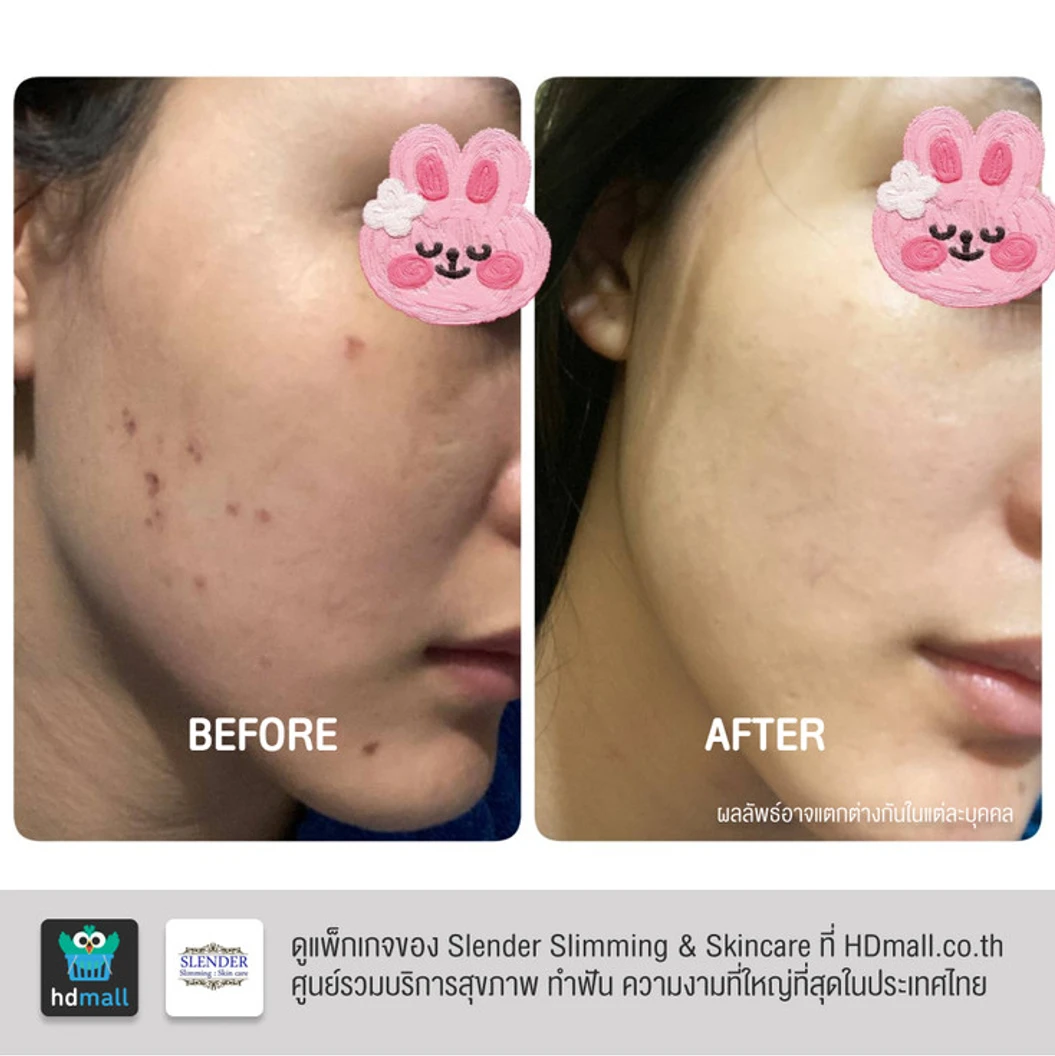 คอร์สฉายแสงฆ่าเชื้อสิว ด้วย Blue Light Laser ลดการอักเสบ ทำให้สิวฝ่อและแห้งลง 2 ครั้ง