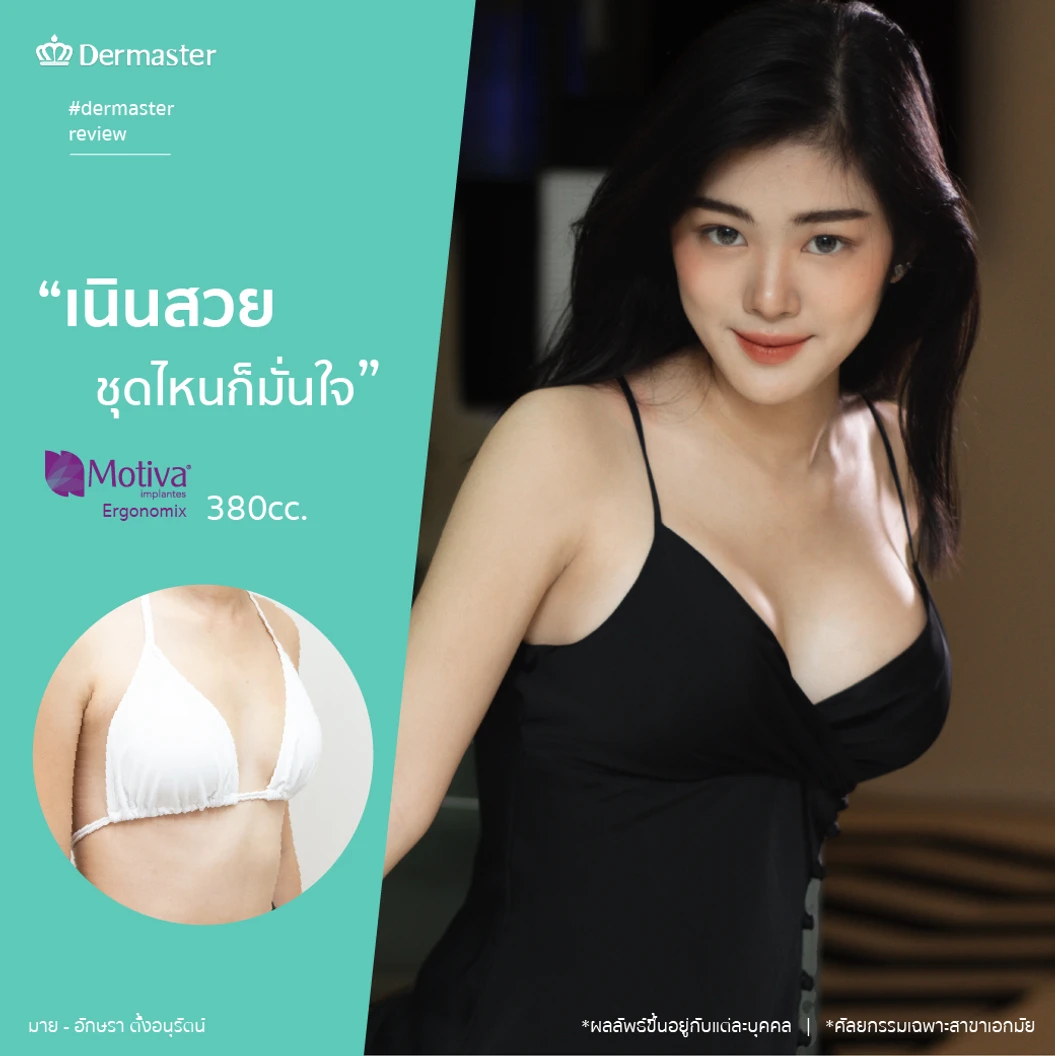 เสริมหน้าอกด้วยซิลิโคน Motiva Ergonomix รุ่นมีชิป ไม่จำกัดซีซี สำหรับเคสเสริมครั้งแรก