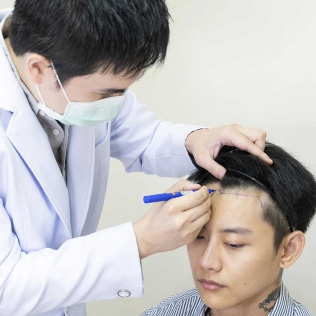 ปลูกผม ด้วยเทคนิค FUE ไม่เกิน 1,500 กราฟต์