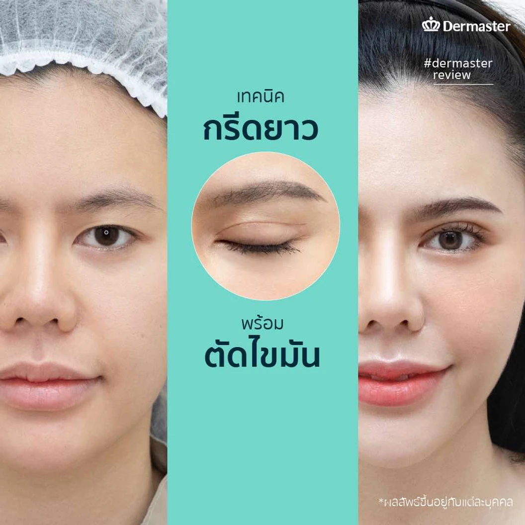 ทำตา 2 ชั้น สำหรับเคสทำครั้งแรก