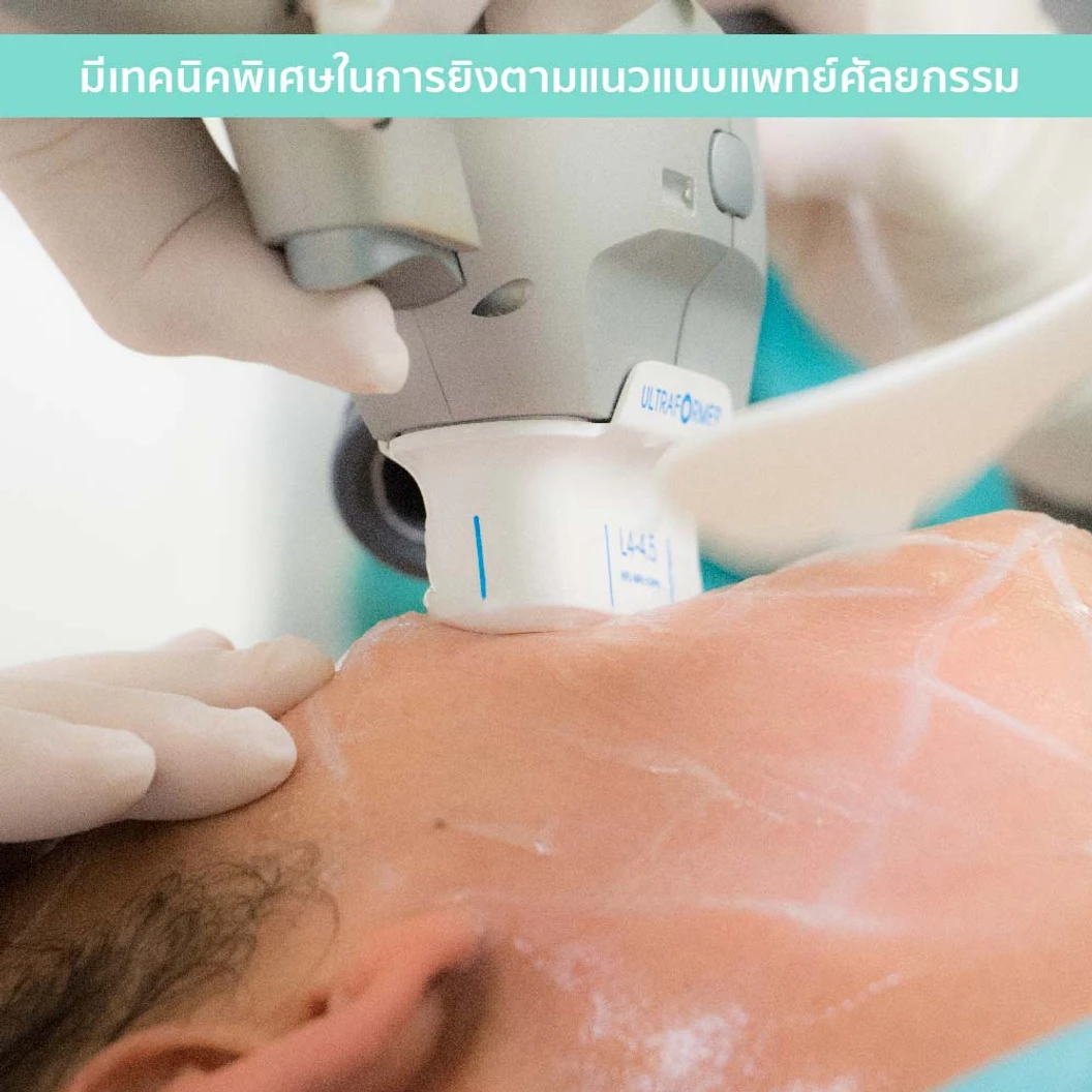 ทำ HIFU ด้วยเครื่อง Ultraformer III 300 ช็อต เพื่อยกกระชับ ปรับรูปหน้า 1 ครั้ง