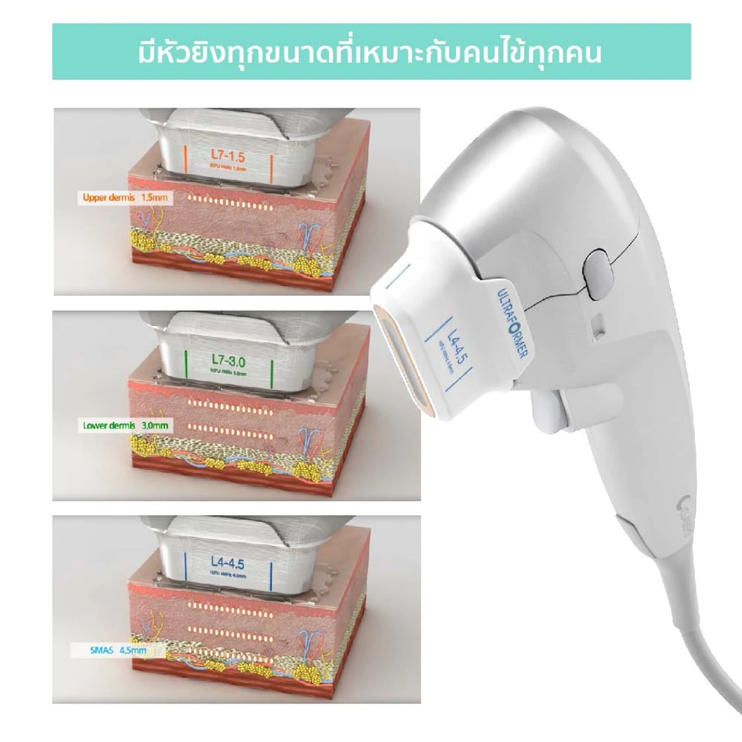 ทำ HIFU ด้วยเครื่อง Ultraformer III 300 ช็อต เพื่อยกกระชับ ปรับรูปหน้า 1 ครั้ง