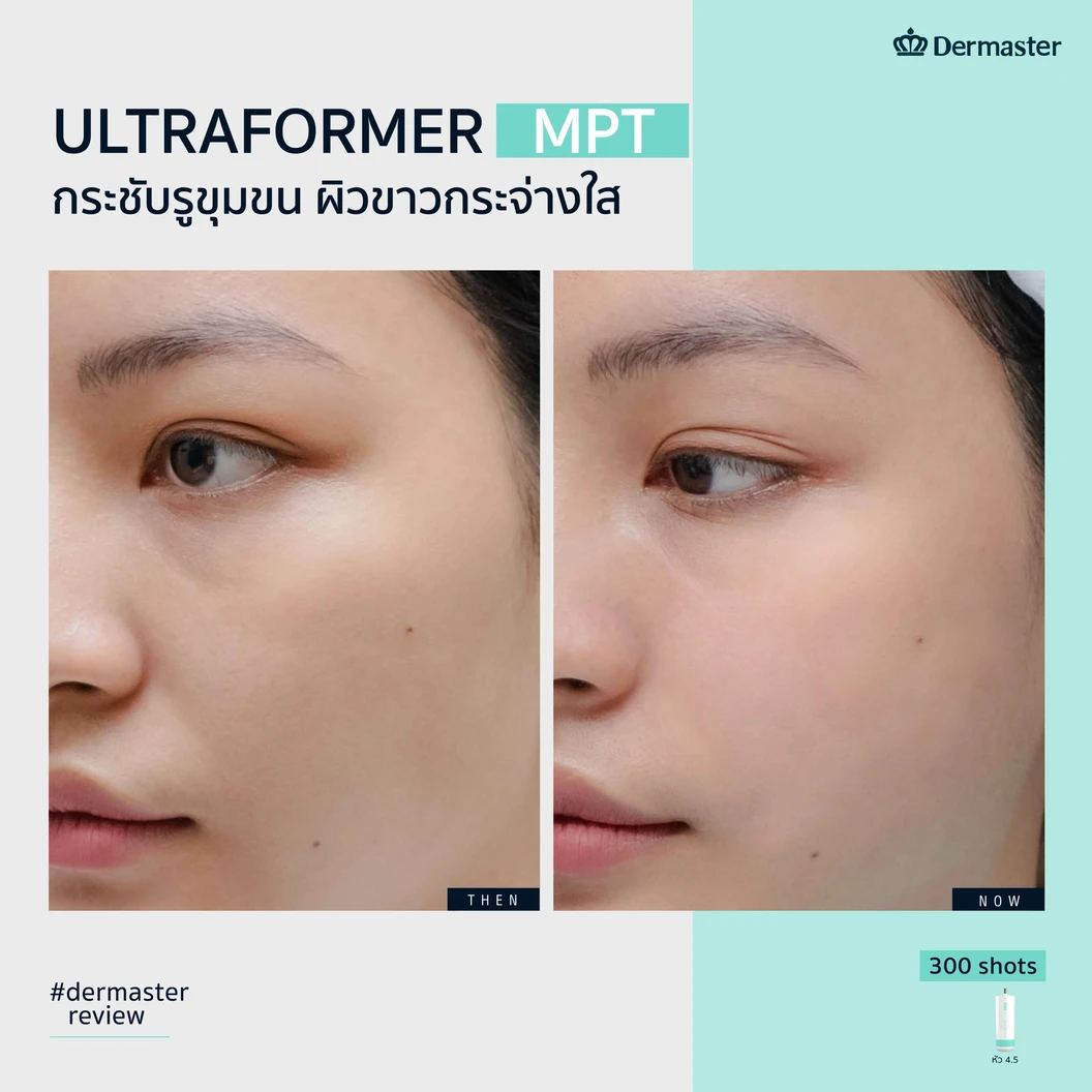 ทำ HIFU ด้วยเครื่อง Ultraformer MPT 300 ช็อต เพื่อยกกระชับ ปรับรูปหน้า 1 ครั้ง