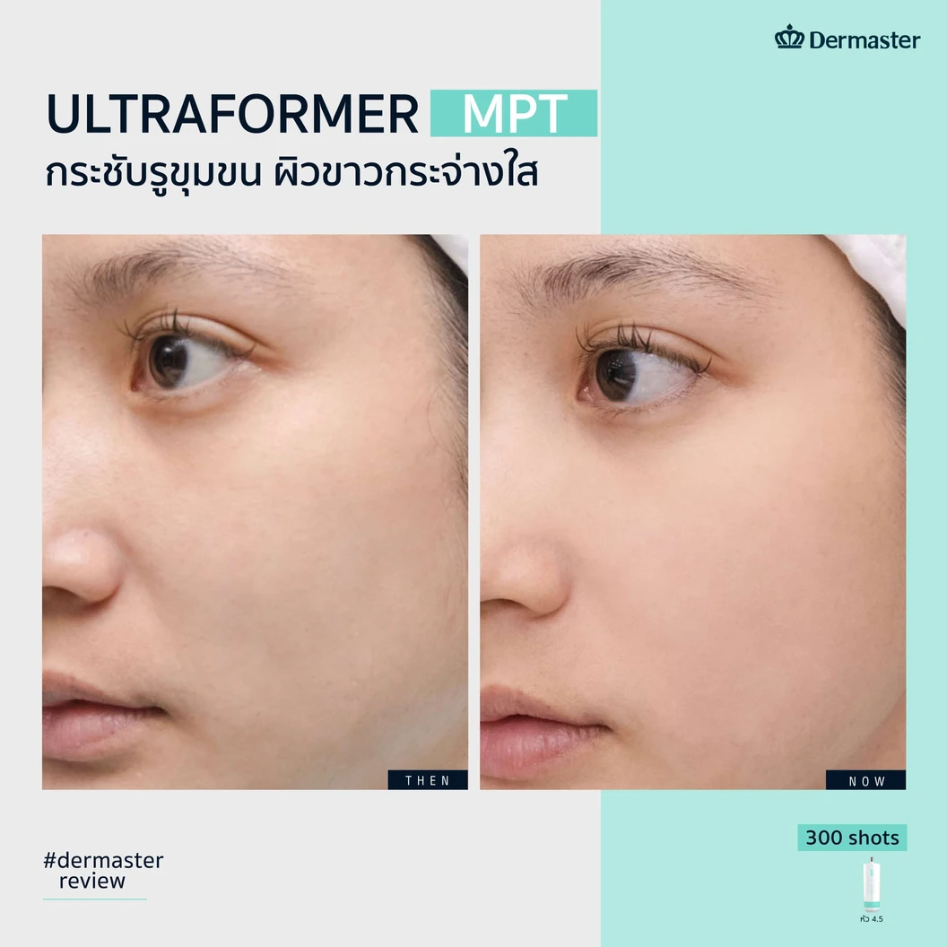 ทำ HIFU ด้วยเครื่อง Ultraformer MPT 300 ช็อต เพื่อยกกระชับ ปรับรูปหน้า 1 ครั้ง