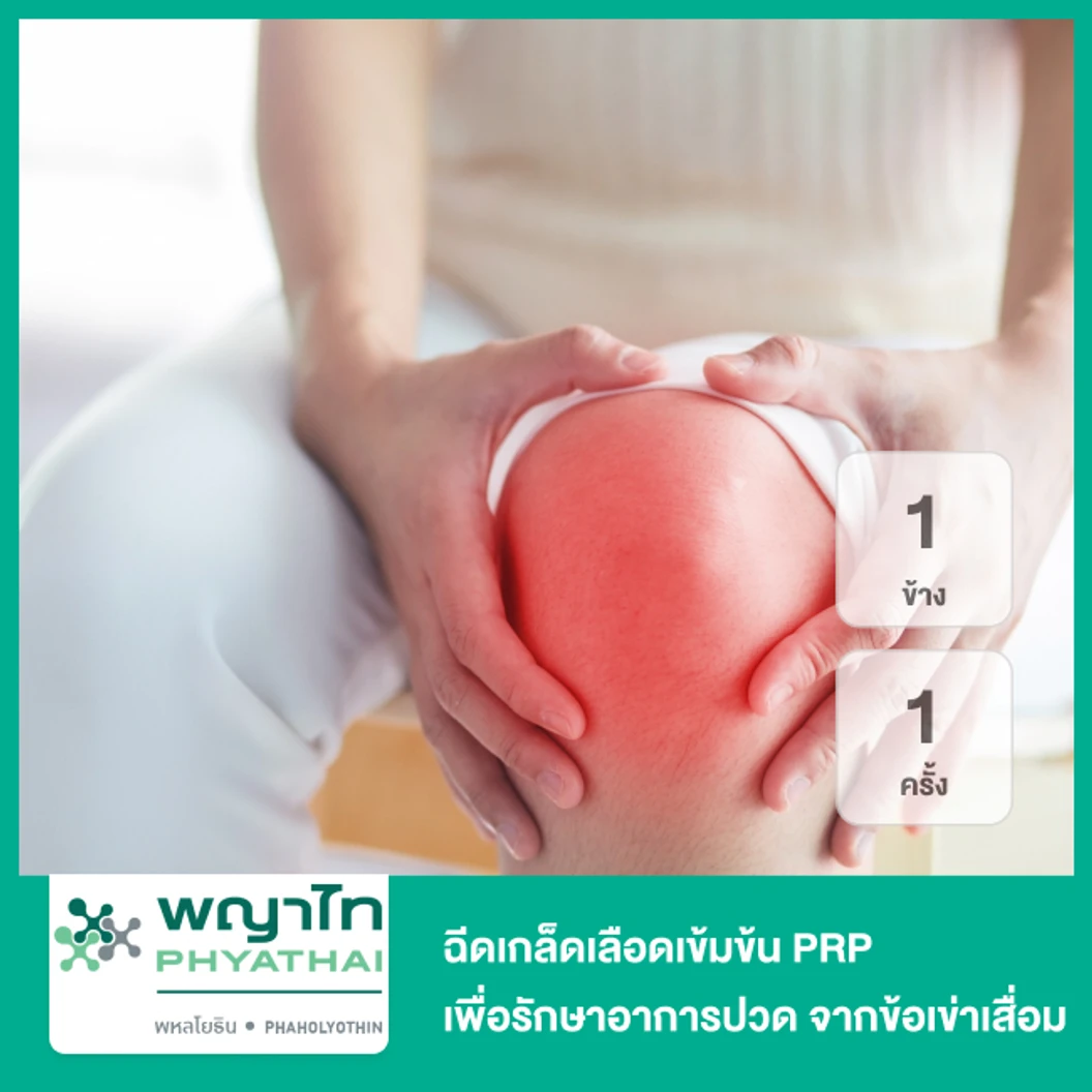 ฉีดเกล็ดเลือดเข้มข้น PRP เพื่อรักษาอาการปวด จากข้อเข่าเสื่อม 1 ข้าง 1 ครั้ง