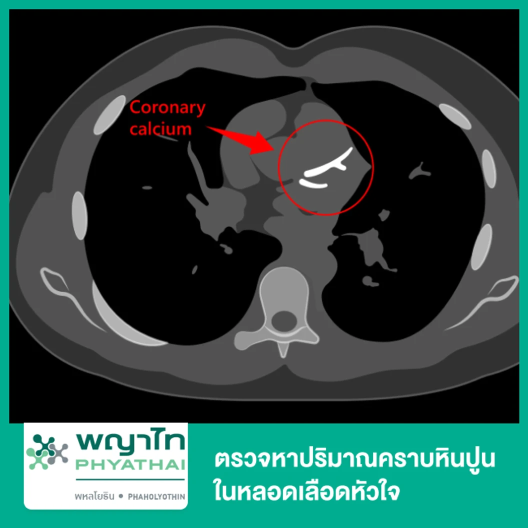 ตรวจหาปริมาณคราบหินปูนในหลอดเลือดหัวใจ (Calcium Scoring) ด้วยเครื่อง CT Scan