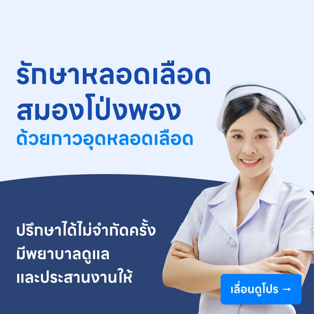รักษาหลอดเลือดสมองโป่งพอง ด้วยกาวอุดหลอดเลือด
