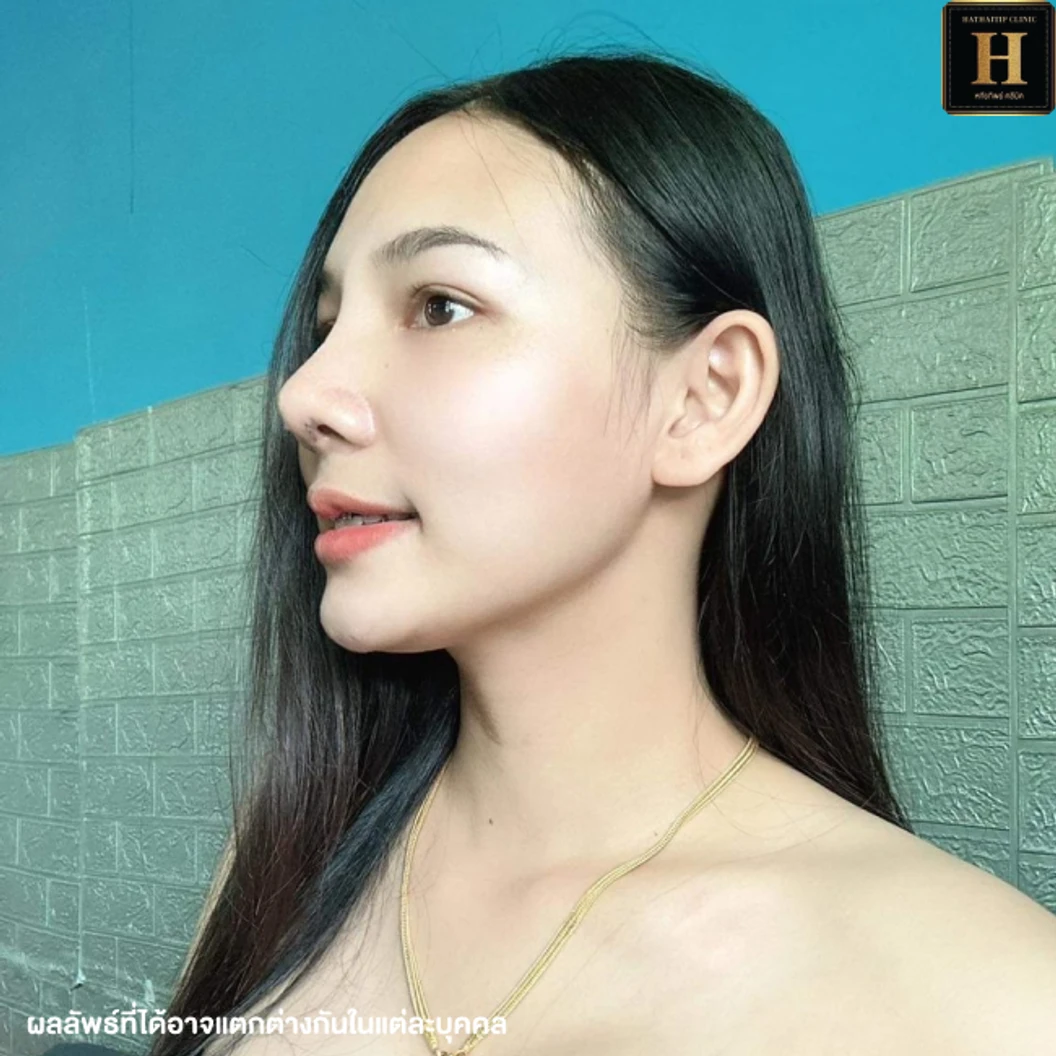 เสริมจมูก ด้วยซิลิโคน Implant Grade สำหรับเคสทำครั้งแรกหรือเคสแก้