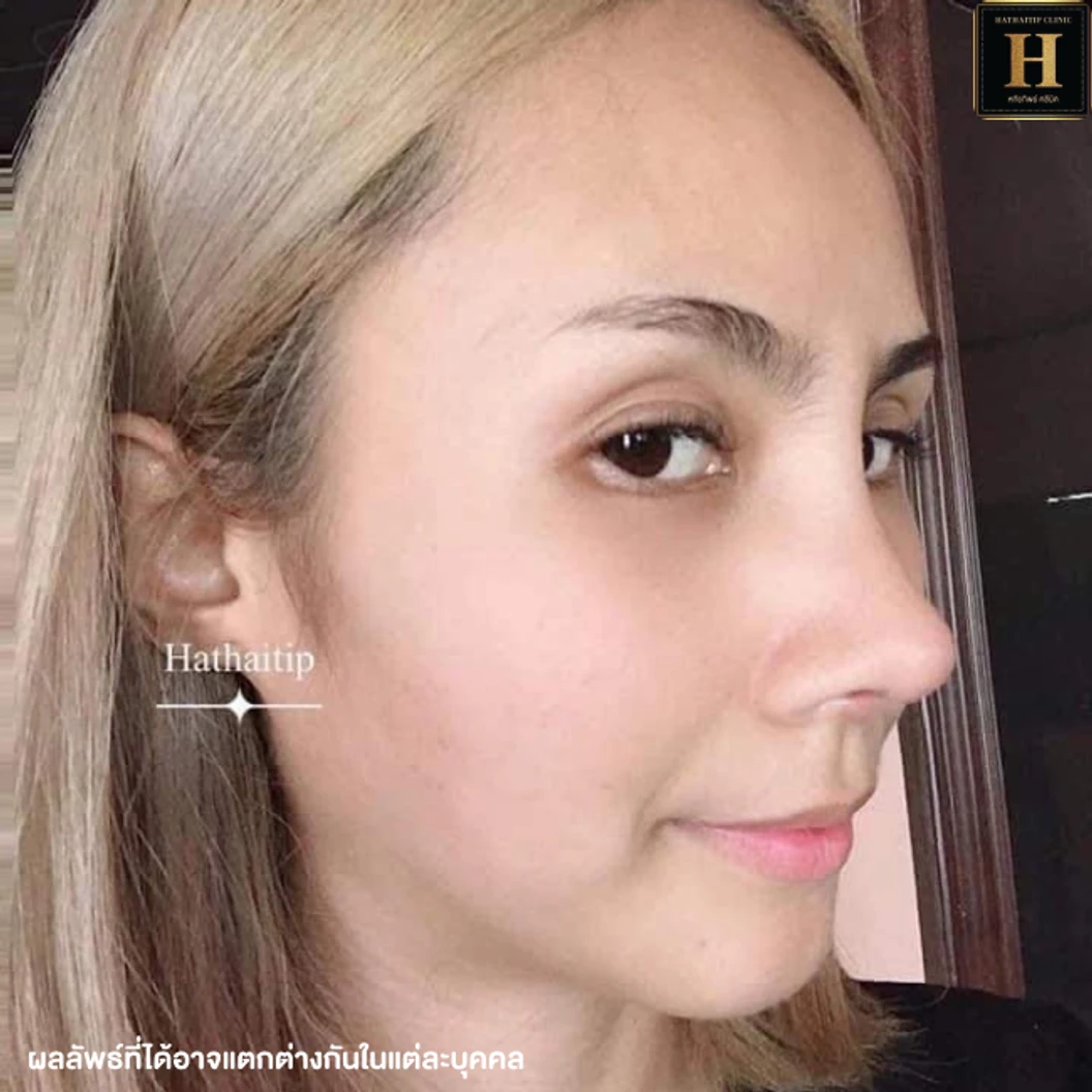 เสริมจมูก ด้วยซิลิโคน Implant Grade สำหรับเคสทำครั้งแรกหรือเคสแก้