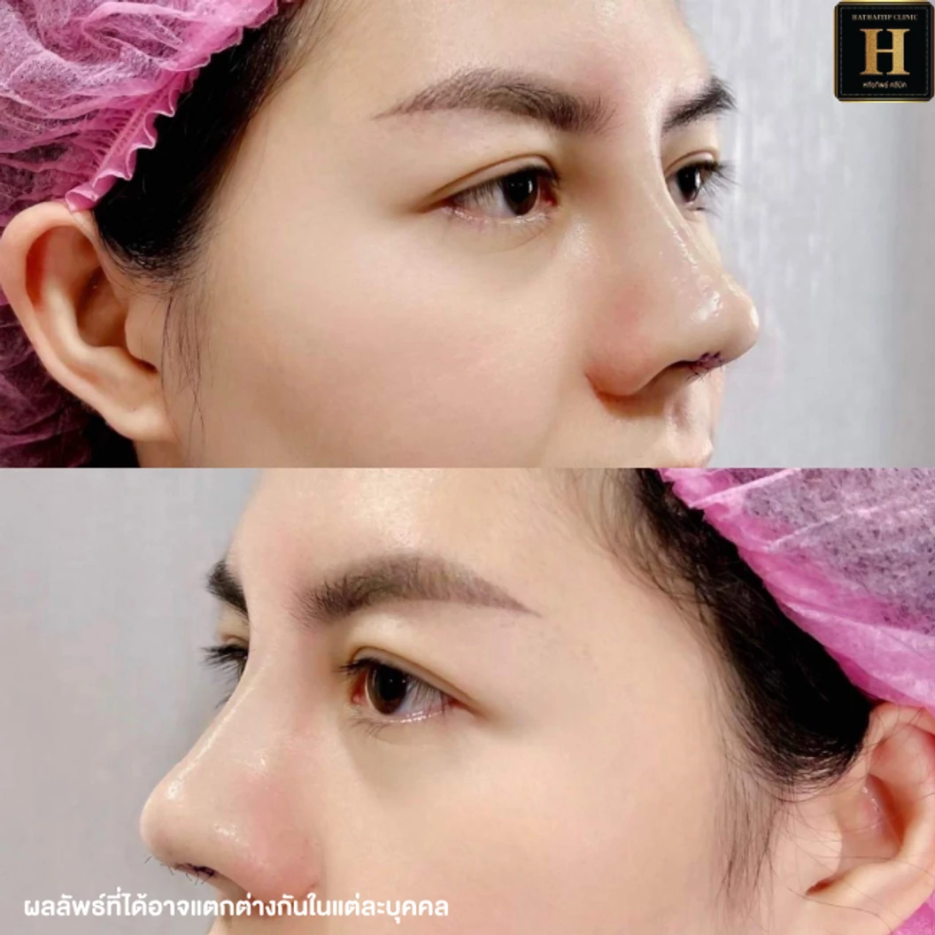 เสริมจมูก ด้วยซิลิโคน Implant Grade สำหรับเคสทำครั้งแรกหรือเคสแก้