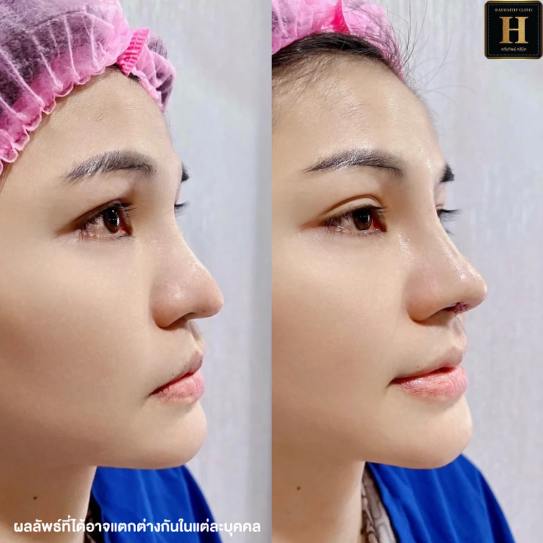 เสริมจมูก ด้วยซิลิโคน Implant Grade สำหรับเคสทำครั้งแรกหรือเคสแก้