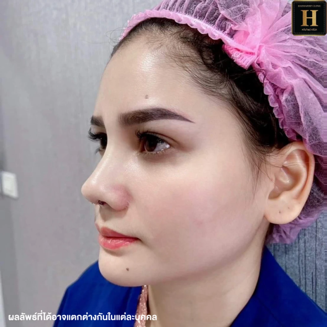 เสริมจมูก ด้วยซิลิโคน Implant Grade สำหรับเคสทำครั้งแรกหรือเคสแก้