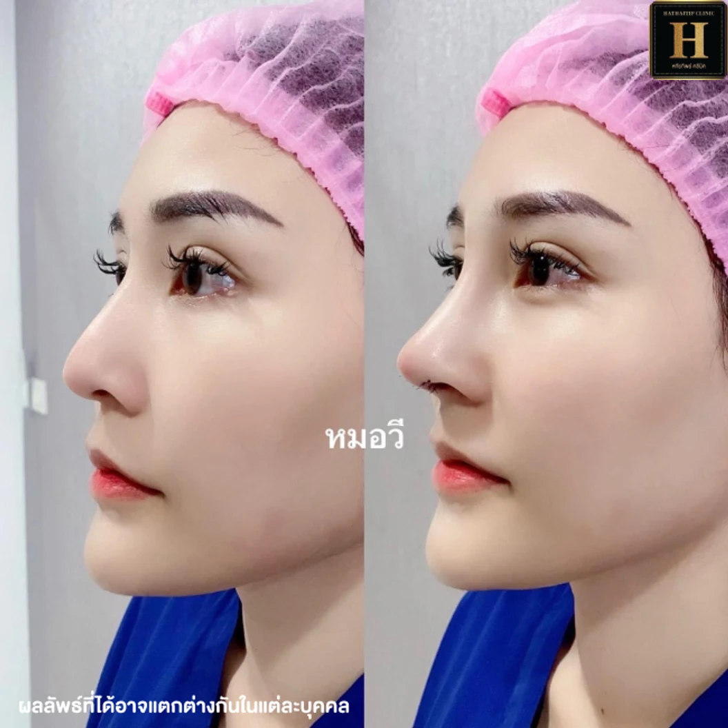 เสริมจมูก ด้วยซิลิโคน Implant Grade สำหรับเคสทำครั้งแรกหรือเคสแก้