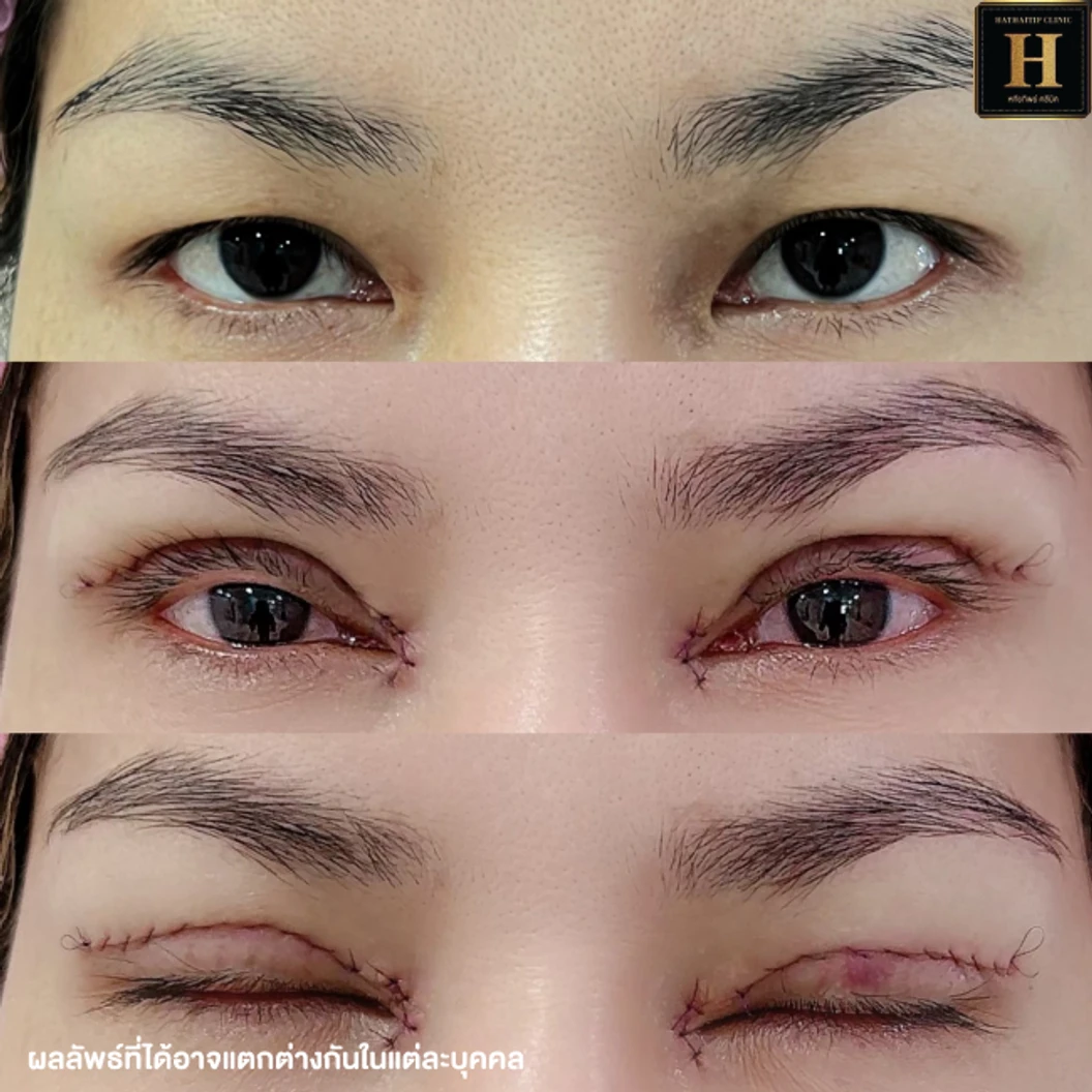 ทำตาสองชั้นแบบกรีดยาว พร้อมตัดไขมัน ตัดหนังตา และยกหางหงส์ สำหรับเคสทำครั้งแรกหรือเคสแก้